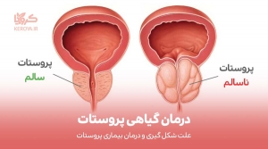 درمان گیاهی بیماری پروستات