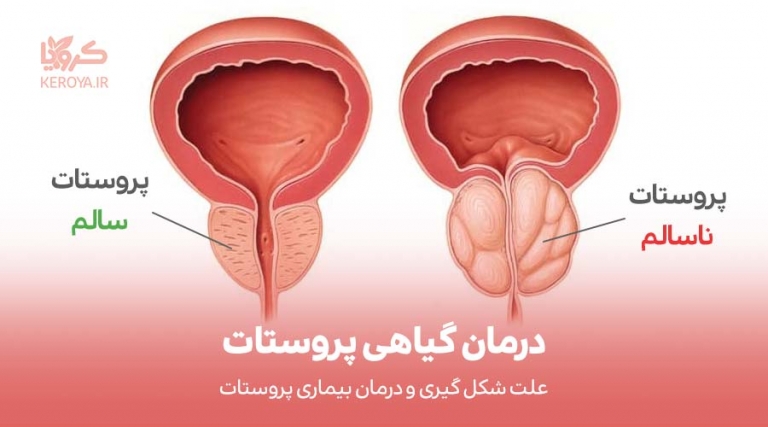 درمان گیاهی بیماری پروستات