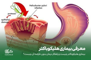 درمان بیماری هلیکوباکتر پیلوری بدون عوراض