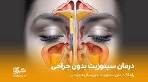درمان سینوزیت بدون جراحی