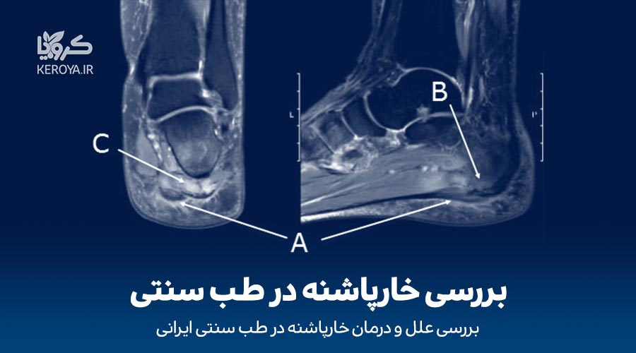 بررسی خارپاشنه در طب سنتی