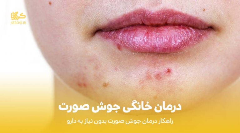 درمان خانگی جوش صورت
