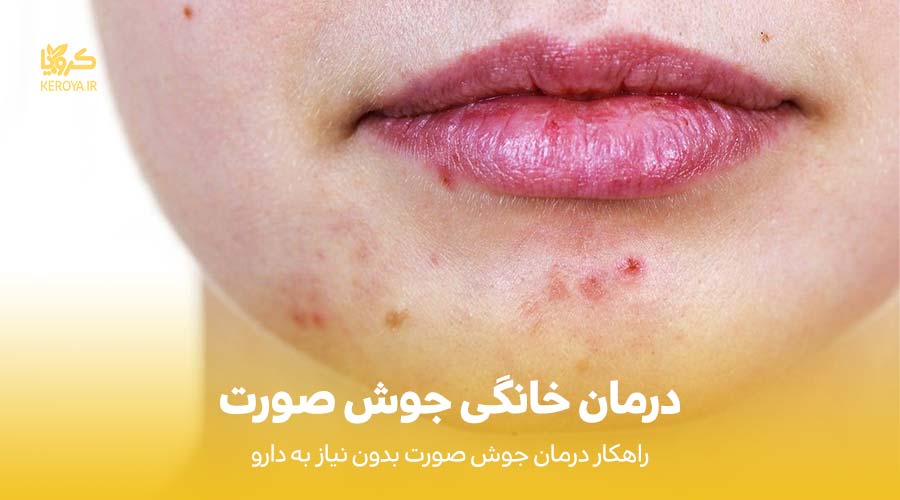 درمان خانگی جوش صورت