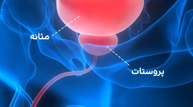 درمان گیاهی پروستات