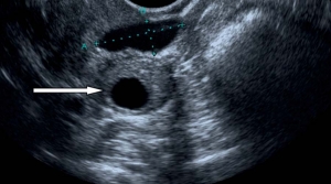 درمان گیاهی کیست تخمدان