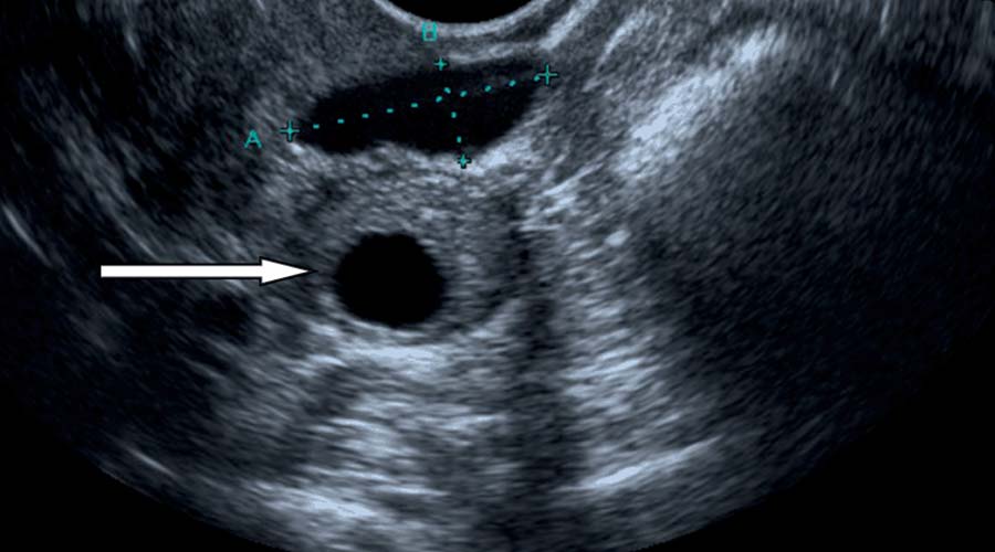 درمان گیاهی کیست تخمدان