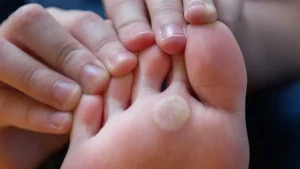 فرق خار پاشنه یا میخچه