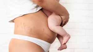 پیشگیری از افتادگی رحم بعد از زایمان