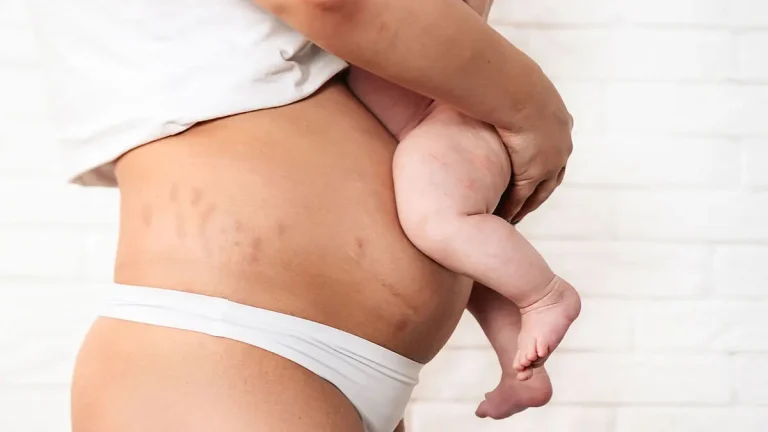 پیشگیری از افتادگی رحم بعد از زایمان