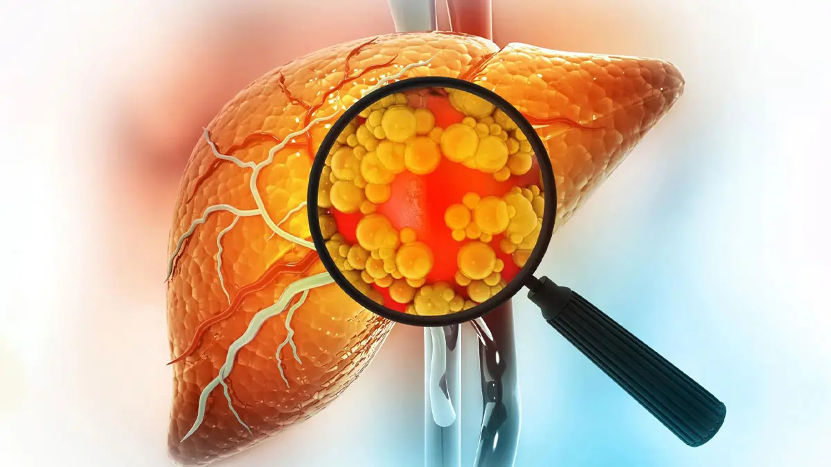 داروی گیاهی برای کبد چرب