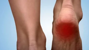 خار پاشنه در ورزشکاران