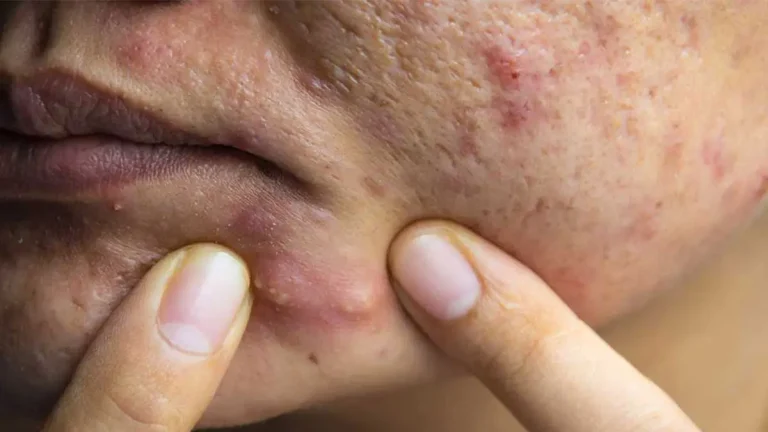 درمان خانگی جوش کیستی