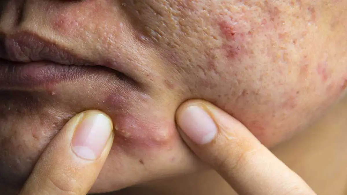 درمان خانگی جوش کیستی